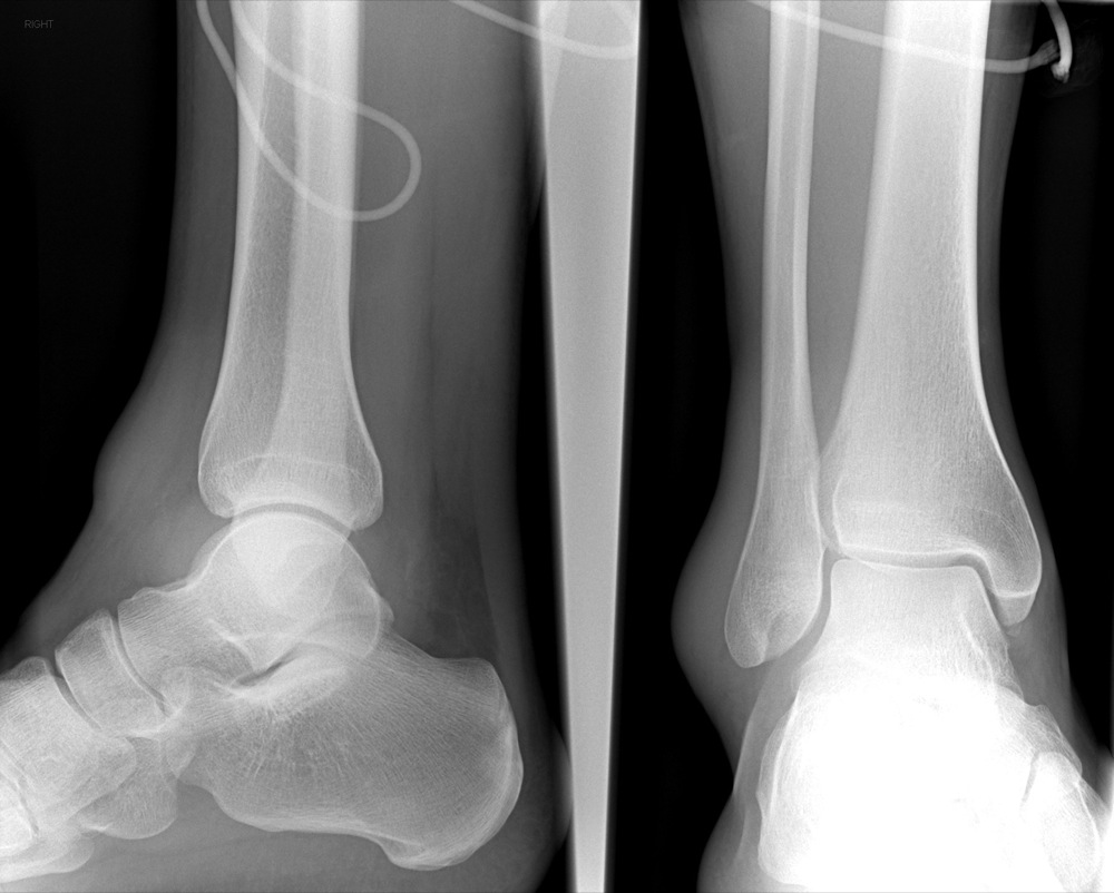 figure-9-from-imaging-of-soft-tissue-lesions-of-the-foot-and-ankle